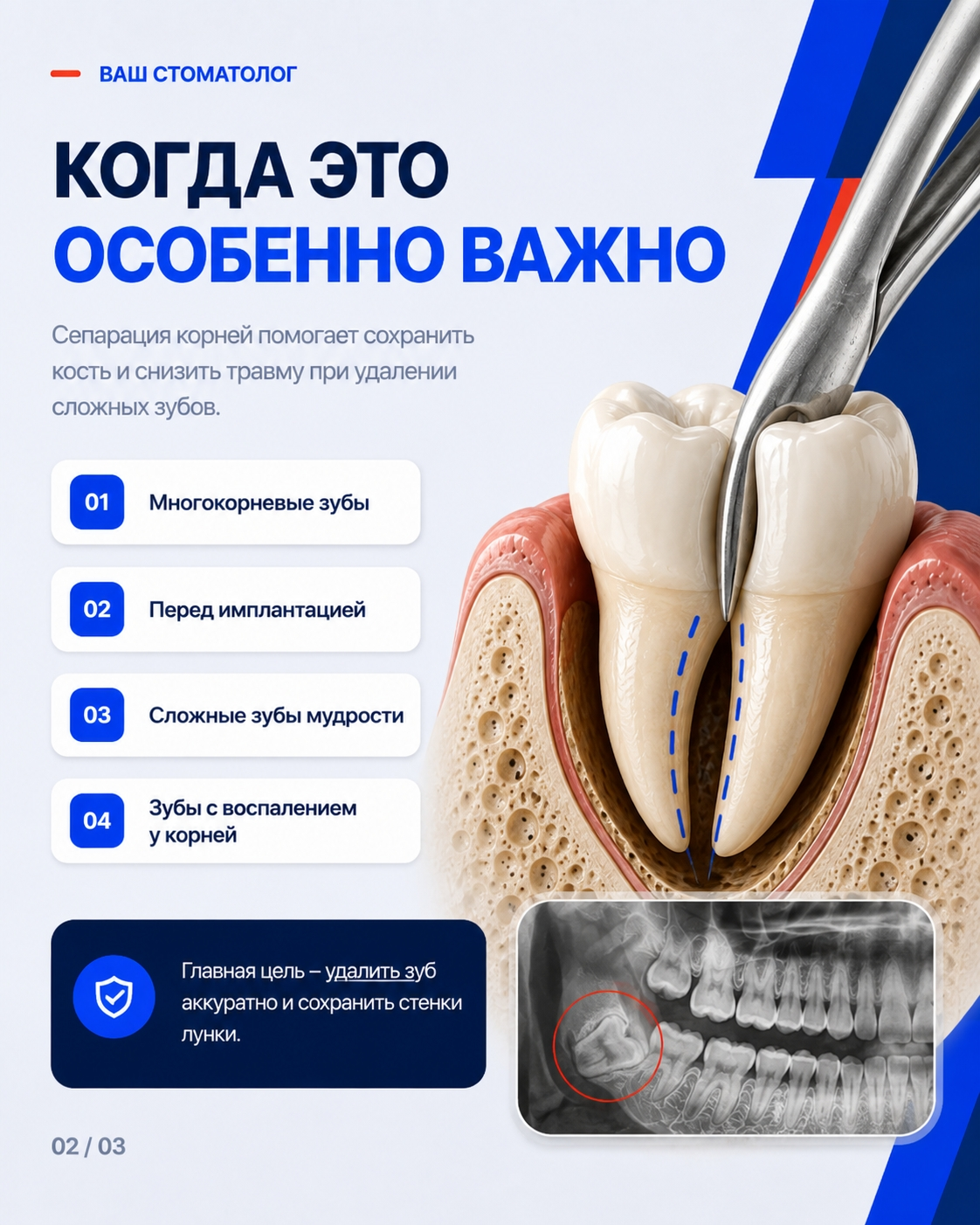 Показания к удалению зуба с сепарацией корней
