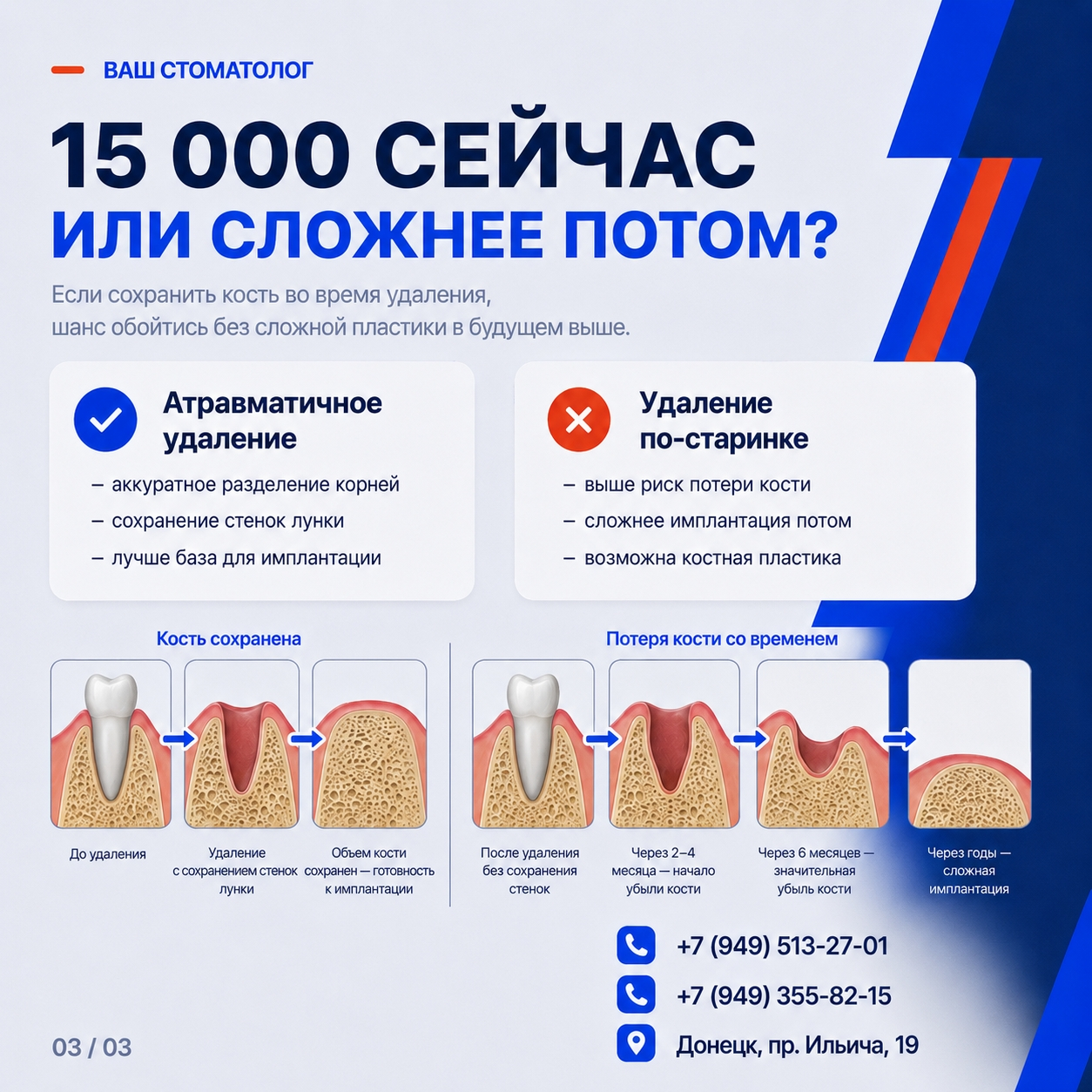 Сравнение атравматичного удаления и потери костной ткани