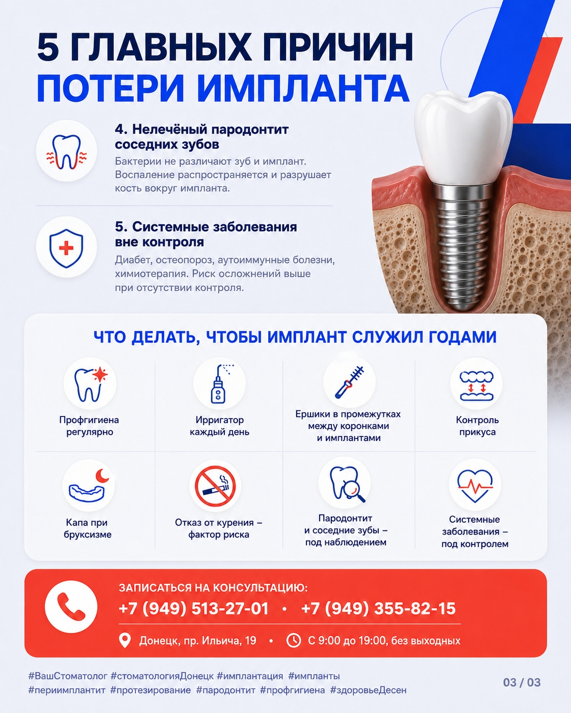 Пять причин потери импланта и правила профилактики