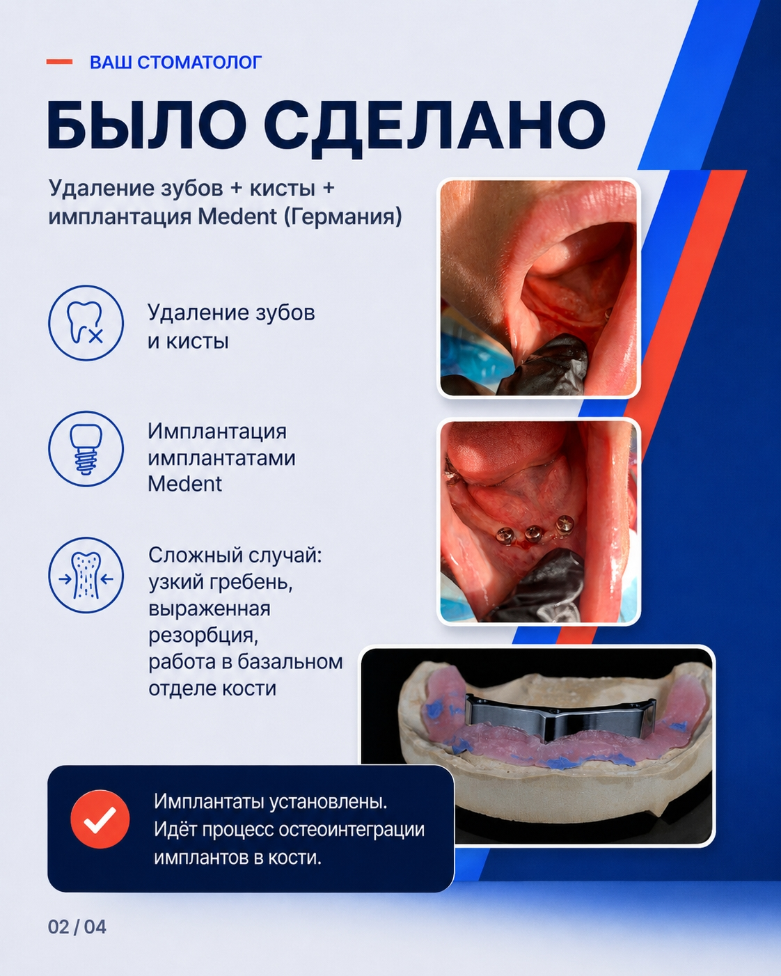 Этапы удаления и установки имплантов Medent