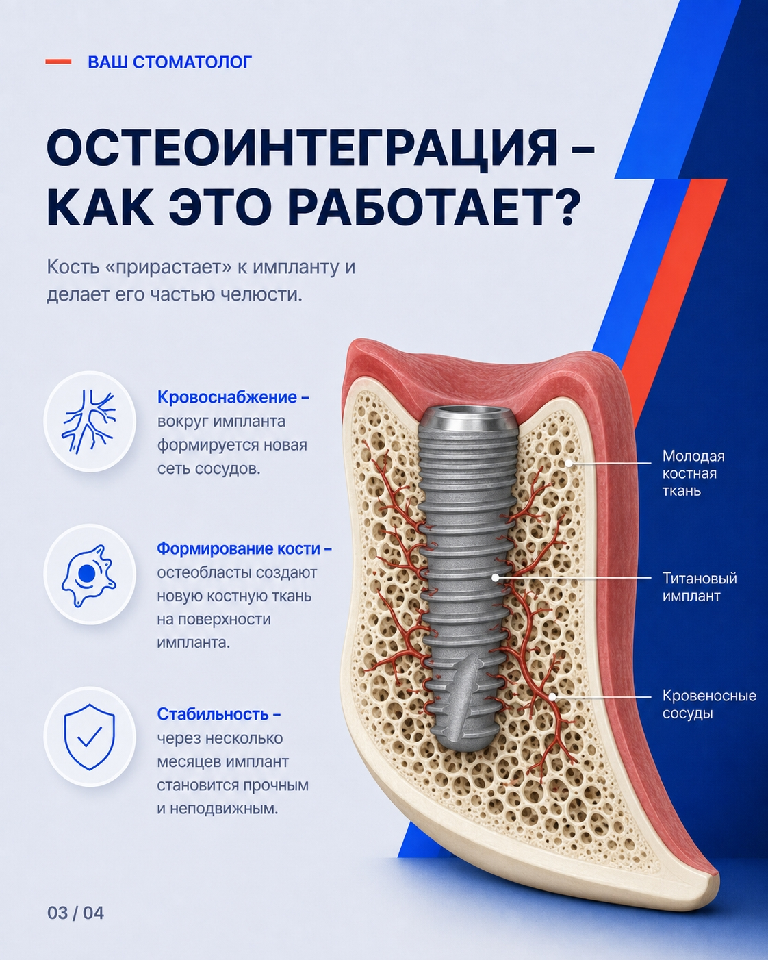 Процесс остеоинтеграции зубного импланта