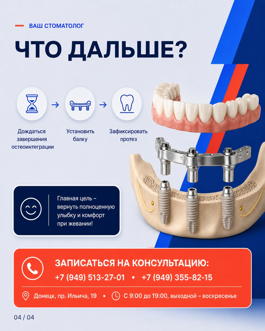 Балочная конструкция на имплантах и будущий протез